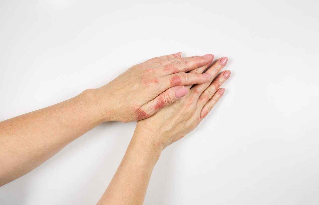 Мокнущая экзема пальцев рук